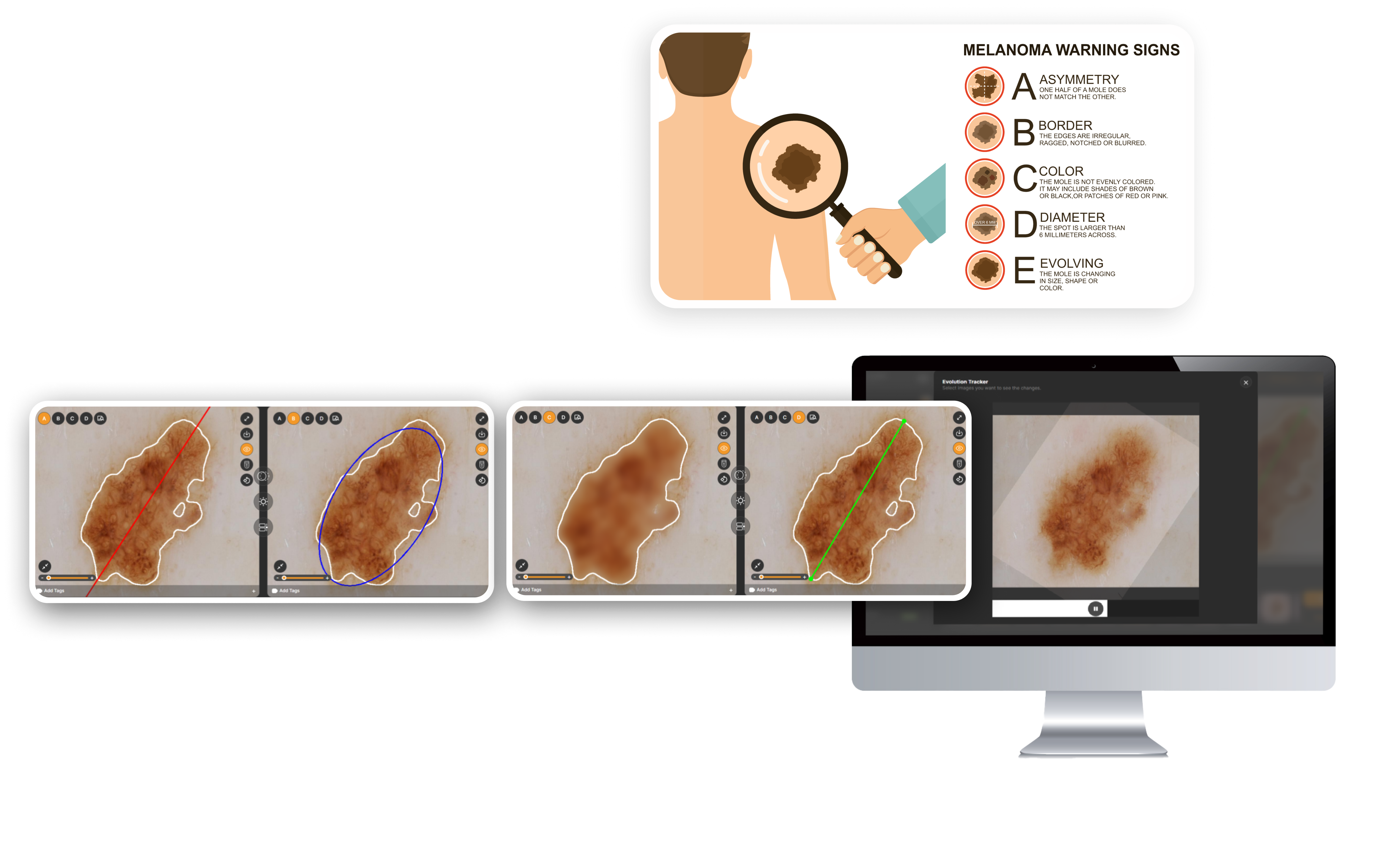 ABCDE guide explanation for checking melanoma warning signs