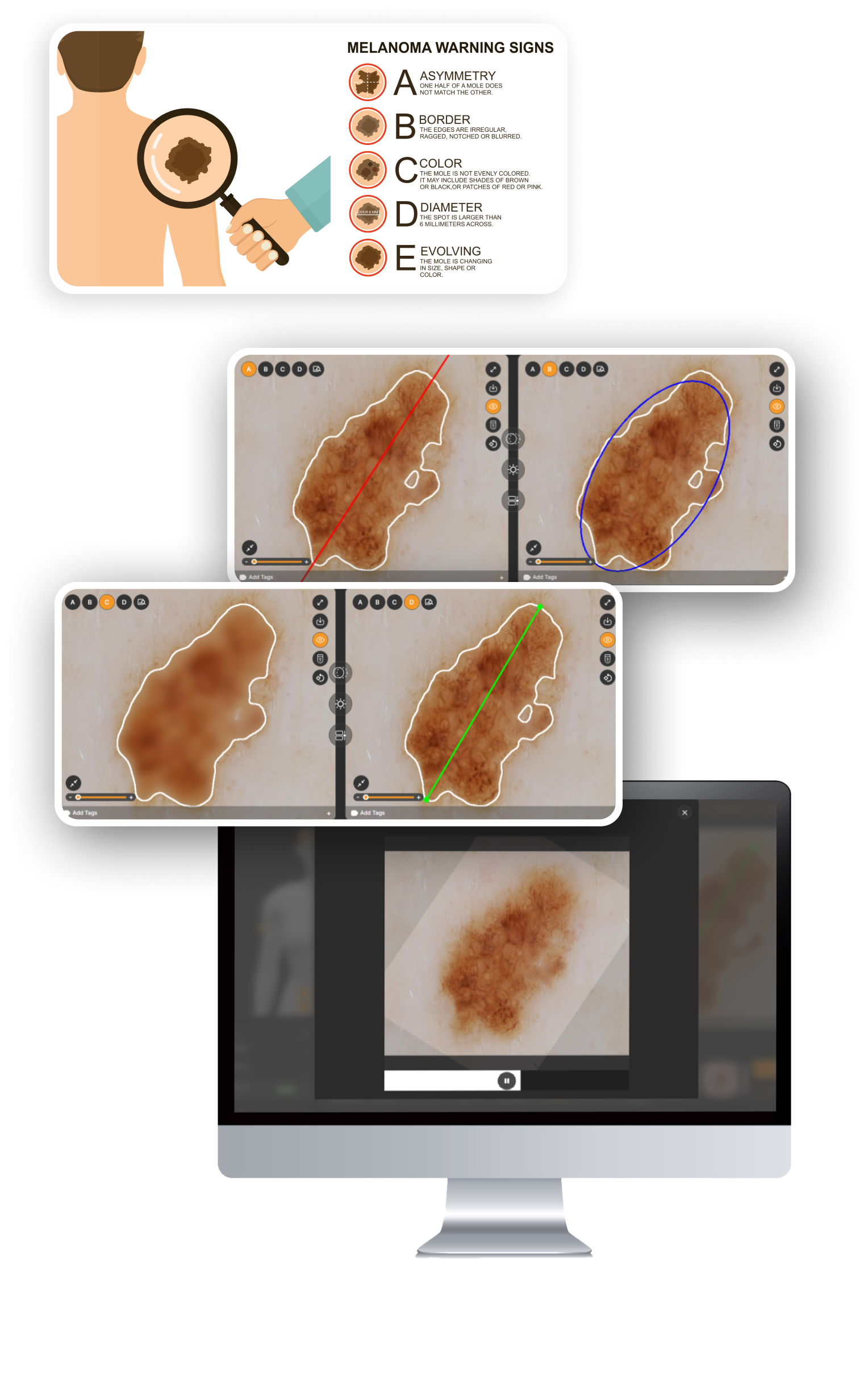 ABCDE guide explanation for checking melanoma warning signs